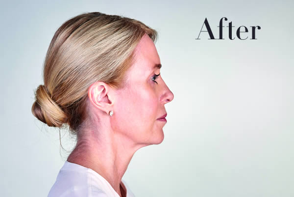 Ultherapy Facelift Review