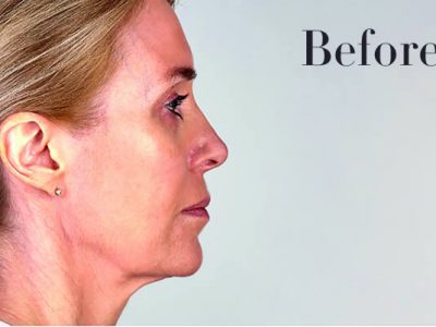 Ultherapy Facelift Review