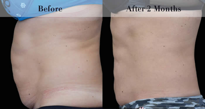 Body Sculpting Before & After