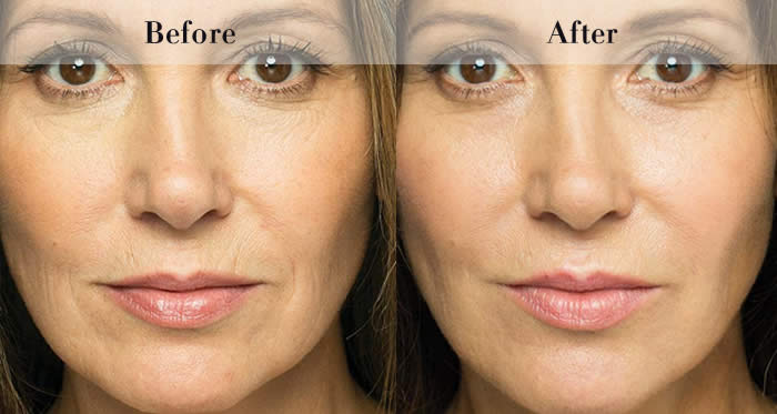 Full Face Dermal Fillers Before & After