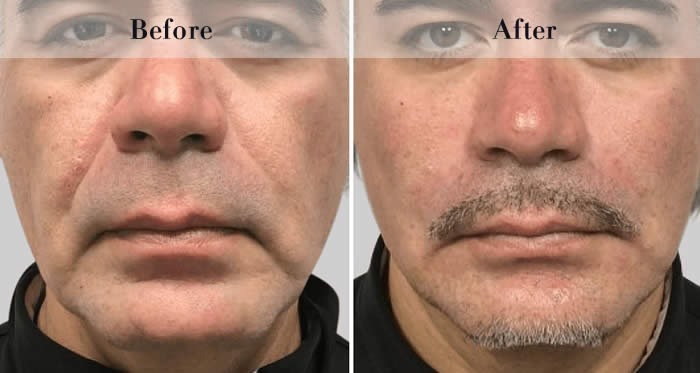 Full Face Dermal Fillers Before & After