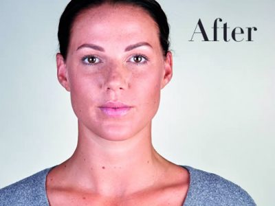 Ultherapy Review
