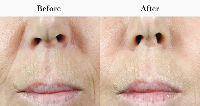 Nasolabial Folds Before & After