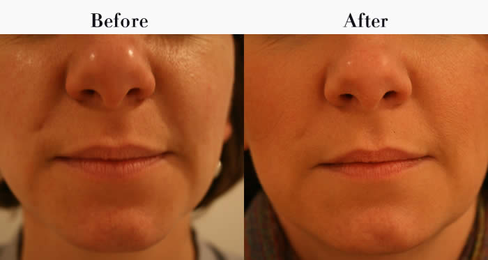 Nasolabial Folds Before & After
