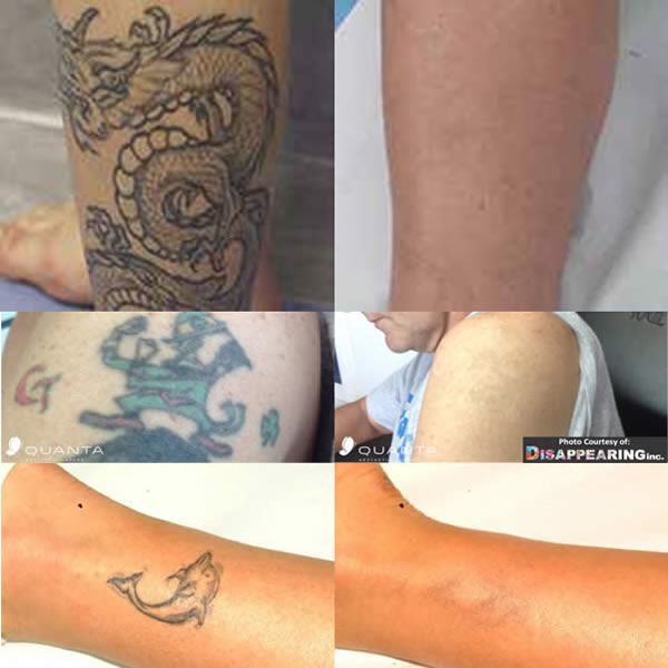 Laser Tattoo Removal in Liverpool | Epilight New Skin Clinic