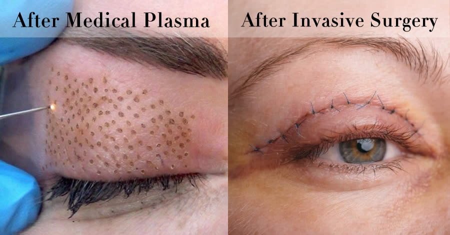 Plasma surgery comparison