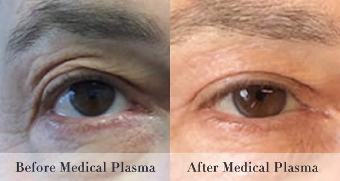 eyelid tightening before and after