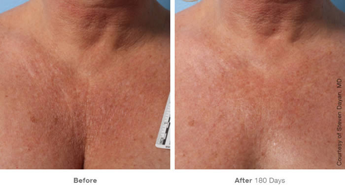 Ultherapy Décolletage Skin Tightening Before & After