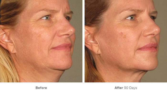 Ultherapy Facelift Before & After