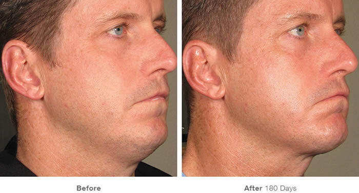 Ultherapy Facelift Before & After