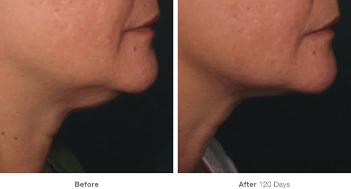 Ultherapy Lower Facelift Before & After