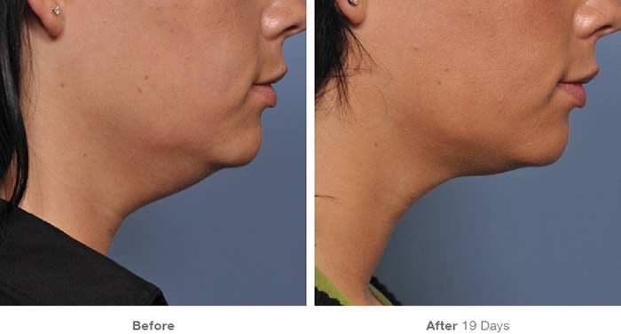 Ultherapy Lower Facelift Before & After