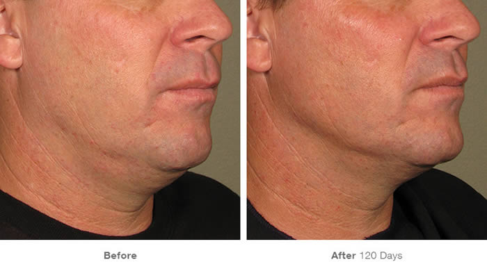 Ultherapy Lower Facelift Before & After