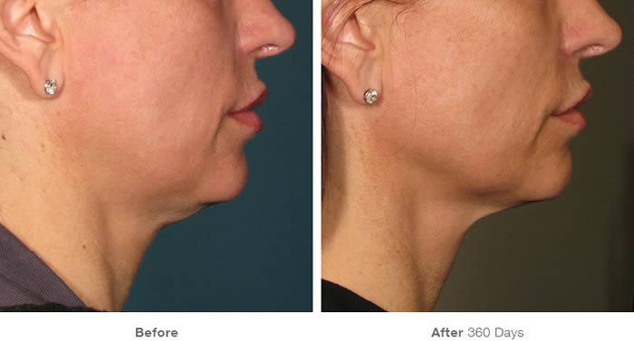 Ultherapy Lower Facelift Before & After