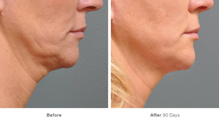 Ultherapy Lower Facelift Before & After