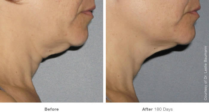 Ultherapy Neck Lift Before & After