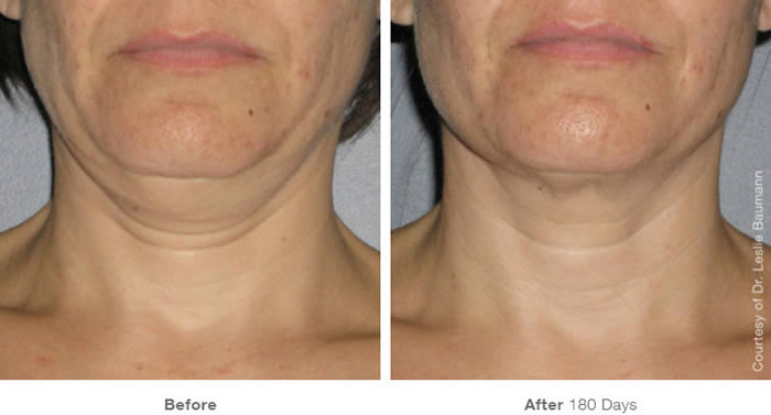 Ultherapy Neck Lift Before & After