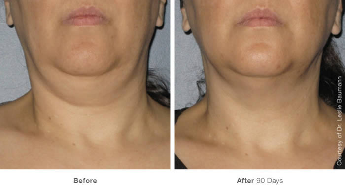Ultherapy Neck Lift Before & After