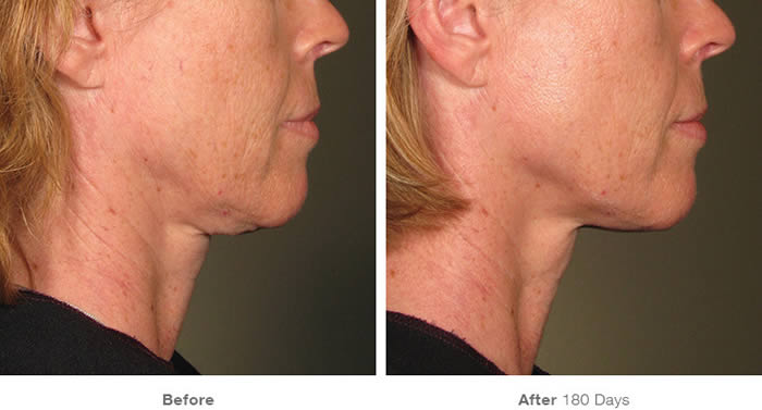 Ultherapy Lower Facelift Before & After