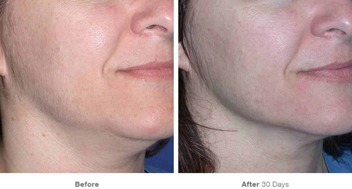 Ultherapy Lower Facelift Before & After