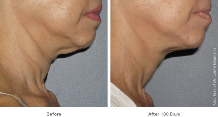 Ultherapy Neck Lift Before & After