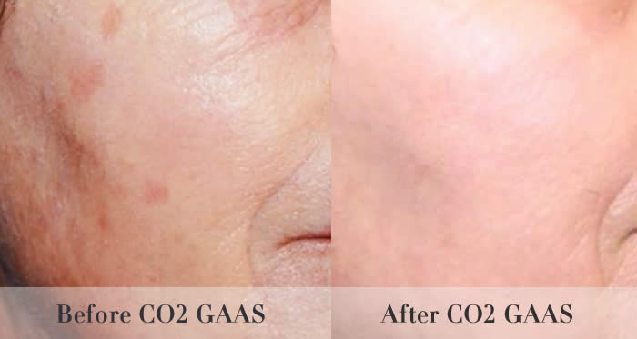 laser skin resurfacing before and after